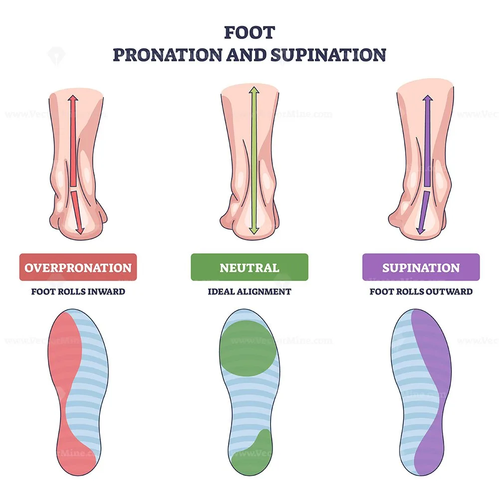 Overpronation Explained