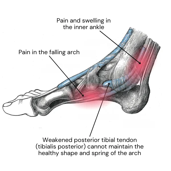 Potential Problems and Pain Points of Walking in Running Shoes