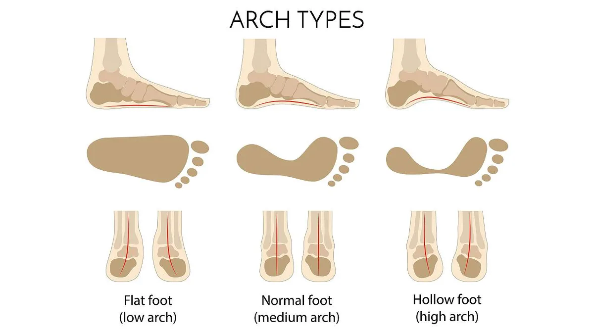 Who Needs Arch Support? Identifying Your Foot Type and Needs
